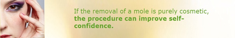 mole removal